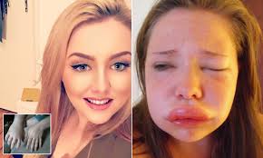 Woman refuses to let remarks get to her after being diagnosed with  Hereditary Angioedema