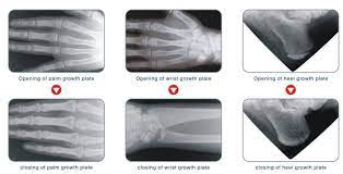 Growth Plate Analysis - Care Plus Rehab & Wellness Centre