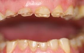 Maybe you would like to learn more about one of these? Que Es El Bruxismo Infantil Caballero Dental Clinic