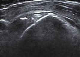 Image result for Rotator Cuff Calcification