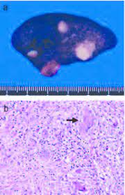Splenic Granulomas A The Cut Surface Of The Spleen Presents With Download Scientific Diagram