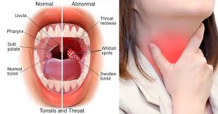 Drink warm fluids without caffeine, such as chicken broth or hot herbal tea with honey. Get Rid Of Tonsillitis And Sore Throat Naturally Fast With This Home Remedy David Avocado Wolfe