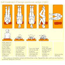 Epley Liberatory Manoeuvre For Bppv Epley Maneuver Self Treatment Tinnitus Remedies