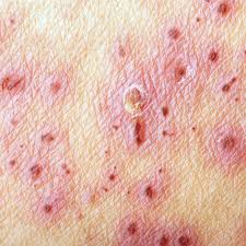 Image result for herpes zoster