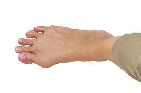 Was Hilft Bei Hallux Valgus Blackroll