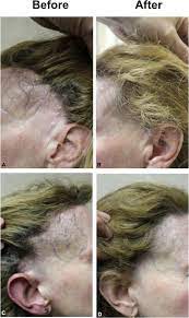 If there is a causative factor for the hair loss, treatment of the condition will usually take care of it (stress, iron deficiency, thyroid). Hair Regrowth And Reversal Of Atrophy In A Patient With Frontal Download Scientific Diagram