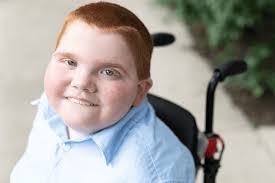 Image result for Muscular Dystrophy