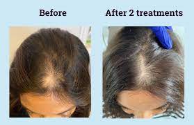 Men, women, and even children can experience hair loss. Steroid Injections For Hair Loss Fact Sheet And Definitive Guide