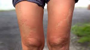 Image result for allergy rash on the legs