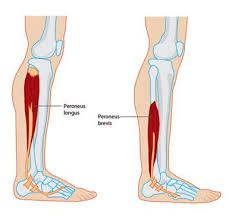 Peroneal Tendinopathy And Tendonitis Peroneus Longus Muscle Weakness Muscle Atrophy