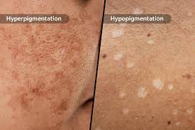 Image result for Postinflammatory Hypopigmentation