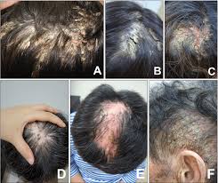 Seborrheic dermatitis is a common skin condition that commonly affects the scalp, face, or inside the ears. Clinical Findings Of Pityriasis Amiantacea Associated With Various Download Scientific Diagram