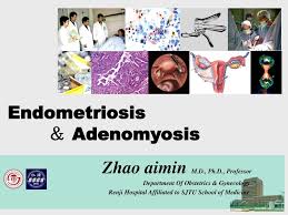 Adenomyosis is a benign disorder of the uterus where the endometrial tissue of the endometrial cavity in the uterus grows into the uterine muscle, damaging the. Ppt Endometriosis Adenomyosis Powerpoint Presentation Free Download Id 6170676