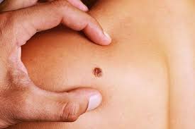 Learn the specific appearance of the common forms of skin cancer and when you should speak with a dermatologist. A Guide For Skin Cancer Symptoms Causes And Types