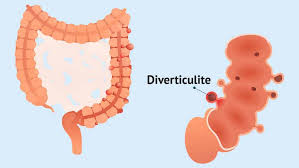 Information and translations of colon sigmoide in the most comprehensive dictionary definitions resource on the web. Doenca Diverticular De Colon Sigmoide Diverticulitis Colonica