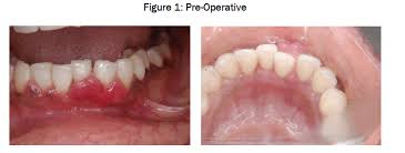 Image result for granuloma gum disease