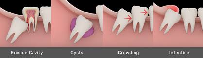 The lack of eating would. Wisdom Teeth Removal Lifecare Dental