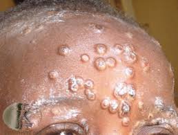 This is followed by a rash that forms blisters and crusts over. Monkeypox Dermnet Nz