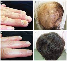 According to the american academy of dermatology, a deficiency in protein or iron may lead to hair loss and consuming an excess of vitamin a can cause the same result. Brittle Nails And Hair Loss In Hypothyroidism Physical Grepmed