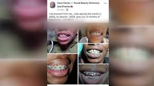 You can't remove invisalign attachments or buttons at home, because it can damage your teeth and make the situation worse. Botched Braces Dentists Concerned About Woman S Facebook Ad For At Home Orthodontics