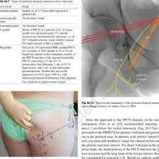 The surgeon uses the thumb to push the tissue toward the depression, reset and smooth. Pdf Posterior Femoral Cutaneous Nerve Entrapment Low Back