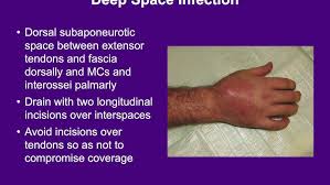 Image result for Hand Infection