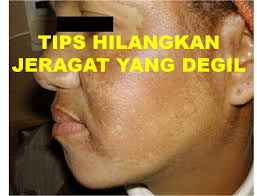 Cara menghilangkan jerawat dengan menggunakan lidah buaya untuk menghilangkan jerawat 3. Petua Menghilangkan Jeragat Yang Degil Jarimenulis Com
