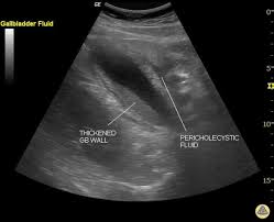 Pada skening intercostal, kandung empedu terlihat diluar hati. Biliary Ultrasound Docnesia Com