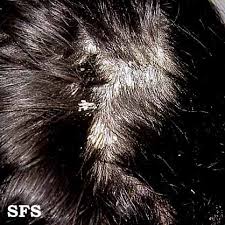 Pityriasis amiantacea is a reaction pattern rather than a specific diagnosis. Pityriasis Amiantacea Wikidoc