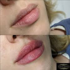 To###edddddd , · photos from lips of london . Lip Fillers Barnet Marylebone London Surgicare Aesthetics