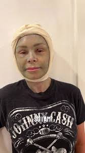 RHOC's Tamra Judge looks completely unrecognizable with swollen face and  'crusty' skin after major plastic surgery