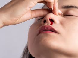 Secara medis dikenali sebagai epistaxis. Kenali 6 Penyebab Ingus Berdarah Dan Cara Mengatasinya