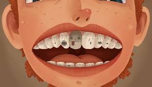 How to fix a dead tooth color. Dead Tooth Causes Symptoms Color And Treatment Dentistry Book