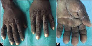 Image result for Thesium nigricans