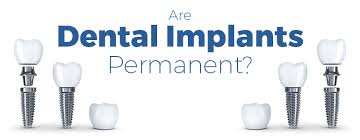 9 myths about tooth implants. How Long Do Dental Implants Last Az Family Dental