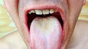 White tongue: Causes, pictures, when to see a doctor, and remedies