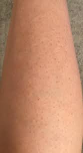 Learning how to prevent ingrown hairs can prevent the situation fast. Hair Removal Bumps Red Marks Ingrown Hairs Strawberry Legs Nothing Works Help Please This Is About 8 Hours After Shaving Skincareaddiction