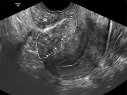 We did not find results for: Ultrasound Evaluation Of Deeply Infiltrative Endometriosis Technique And Interpretation Springerlink