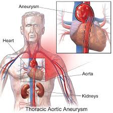As the name suggests, this type happens in your aorta. A Ruptured Aneurysm Could Lead To Sudden Death The Star