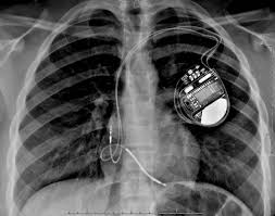 Pacemaker & icd are two different devices. A New Study On Legacy Pacemakers Mri Scanning