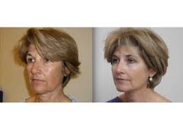 I would probably recommend ultherapy if you are not interested in face lift surgery. Why Soft Silhouette Is The Right Solution For You