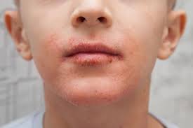 It clears up quickly with antibiotics. Dry Skin Around The Mouth Causes Treatment And Remedies
