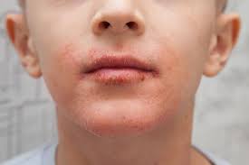 Sometimes, i dilute it with squalane oil and leave it on overnight. Dry Skin Around The Mouth Causes Treatment And Remedies