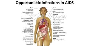 Image result for AIDS-Defining Illness