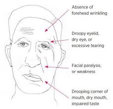 In reality, stroke symptoms are quite different, and bell's palsy. Management Of Bell S Palsy Australian Prescriber
