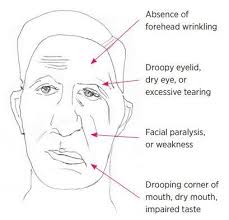 With bell's palsy, your face droops on one side or, rarely, both sides. Management Of Bell S Palsy Australian Prescriber