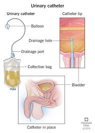 Image result for Continuous Bladder Irrigation