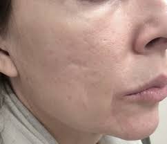 Just like the name says, the process requires the use of small needles to create tiny punctures in the skin. Shedding Microneedling Microneedling For Hair Loss What S The Best Needle Length It Depends Side Effects Aftercare The Final Takeaway Fredelinc