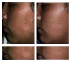 Most patients have a history of atopy, and pityriasis alba may be a minor manifestation of atopic dermatitis. Double Blind Placebo Controlled Randomized Study Comparing 0 0003 Calcitriol With 0 1 Tacrolimus Ointments For The Treatment Of Endemic Pityriasis Alba
