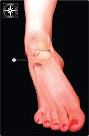 This is the ligament that is most commonly sprained with lateral ankle sprains. Aspetar Sports Medicine Journal Ankle Sprain Diagnosis And Therapy Starts With Knowledge Of Anatomy